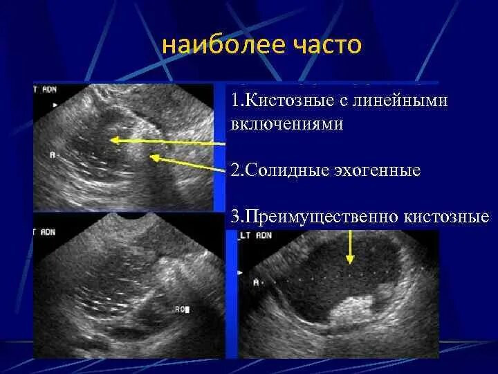 Признаки кистозных изменений. Солидное образование яичника на УЗИ. Кистозно-Солидное образование яичника УЗИ. Кистозно-Солидное образование. Кистозные образования яичников.