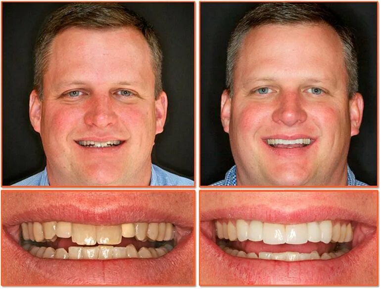 Стачивание передних зубов. Идеальные зубы. Установленных до и после