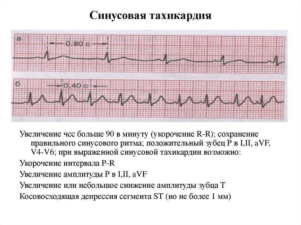 ЭКГ тахикардия синусовый ритм. Синусовая тахикардия ЭКГ признаки. ЭКГ при синусовой тахикардии. Кардиограмма при синусовой тахикардии.