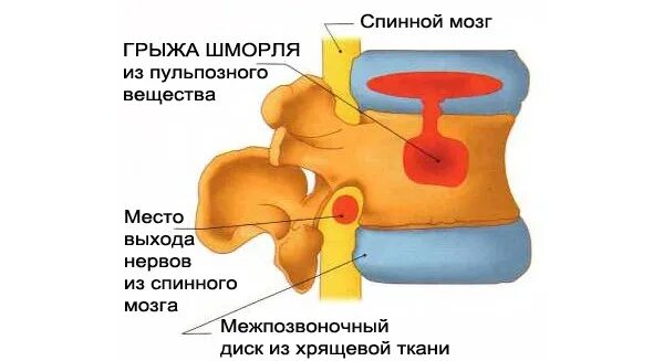 Что такое грыжа шморля как лечить. Хрящевая грыжа позвоночника. шморля грыжа на позвоночнике. узелки шморля.
