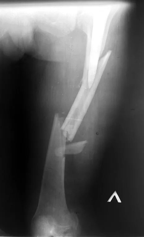 бедренная кость перелом со смещением восстановление