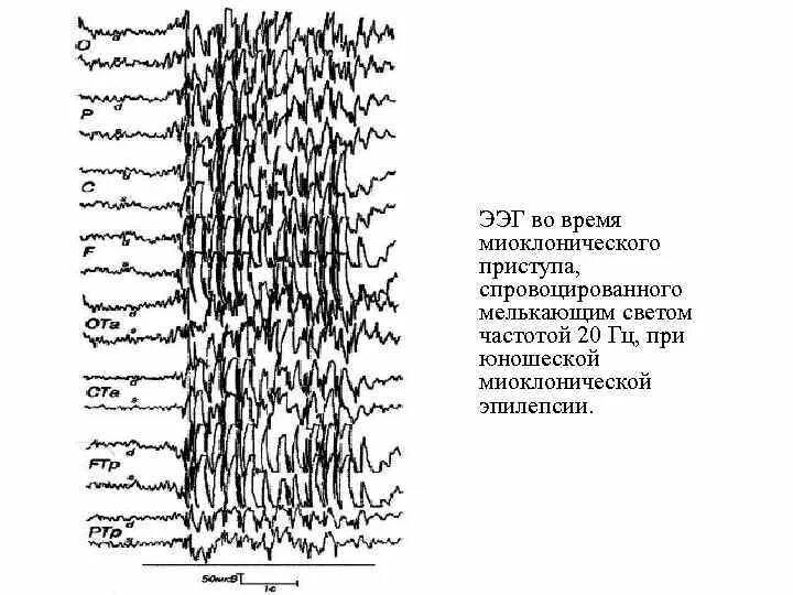 Ээг при эпилепсии. Ээг при эпилепсии