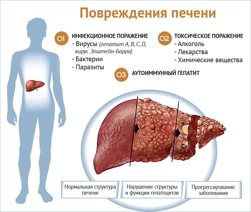 Токсическое поражение печени. 5 причин печень