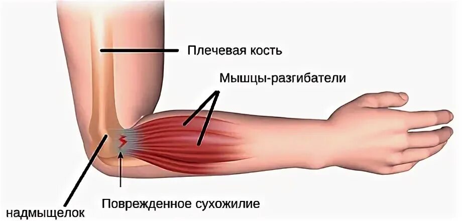 Локтевой эпикондилит мкб