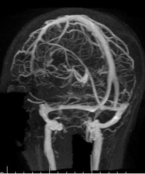 Венография головного мозга. Кт ангиография сосудов головного мозга. Мрт ангиография сосудов головного мозга. Рентген ангиография сосудов головного мозга. Ангиограмма сосудов головного мозга рентген.