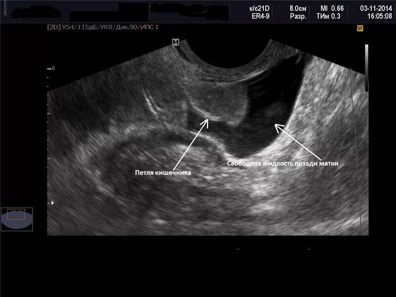 Позадиматочное пространство свободная жидкость УЗИ. УЗИ малый таз жидкость в позадиматочном пространстве. Жидкость в дугласовом пространстве на УЗИ. Жидкость позади маточного пространства УЗИ.