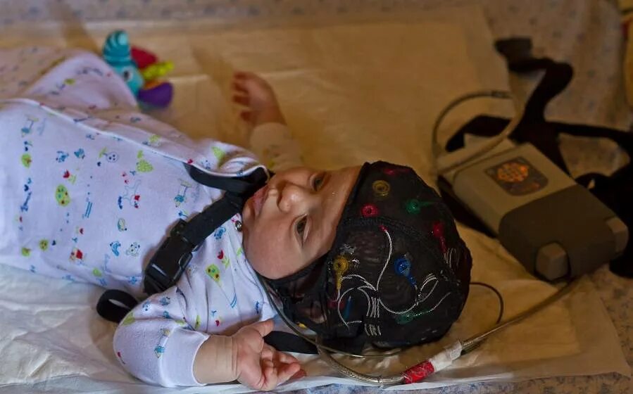 Ишемия мозга. Неонатология новорожденных. Поражение головного мозга у детей. Ишемия головного мозга у новорожденного. Ишемия у новорожденного.