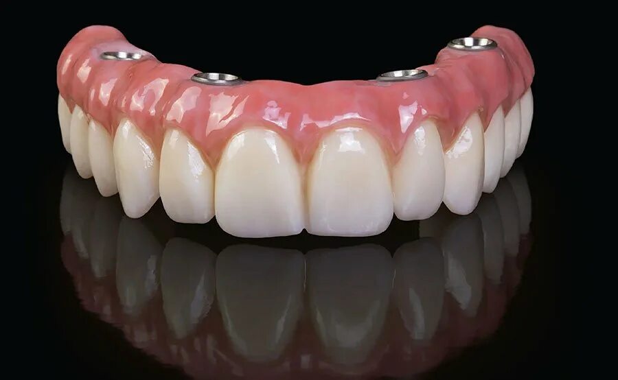 покрывной протез на имплантах. импланты nobel biocare. All on 4 имплантация нобель. протезы на 4 х имплантах. протезы на 4 х имплантах.