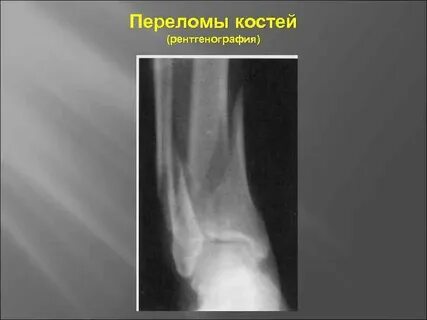 Рентген в травматологии