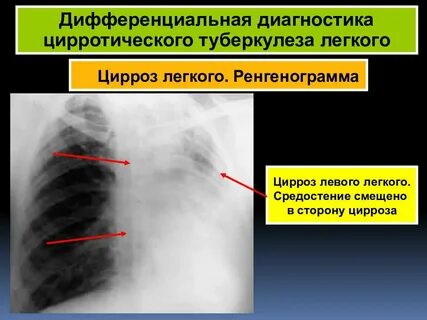 Цирроз легкого