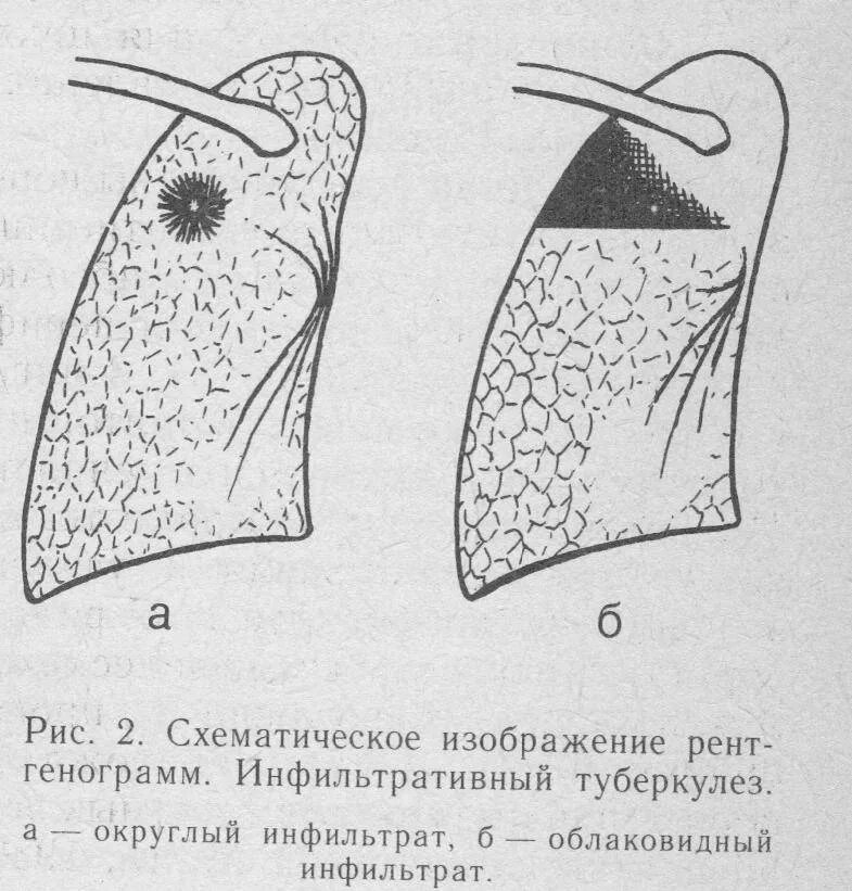 Бронхолобулярный инфильтративный туберкулез. Бронхолобулярный инфильтрат. Инфильтративный туберкулез легкого. Инфильтративный туберкулёз лёгких симптомы. Фазы очагового туберкулеза