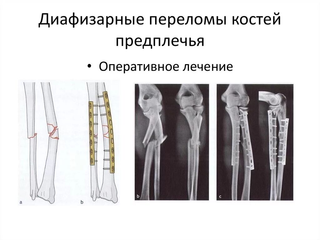 Экстрамедуллярный остеосинтез. Диафизарный перелом костей предплечья. Остеосинтез диафиза локтевой кости. Экстрамедуллярный остеосинтез предплечья.