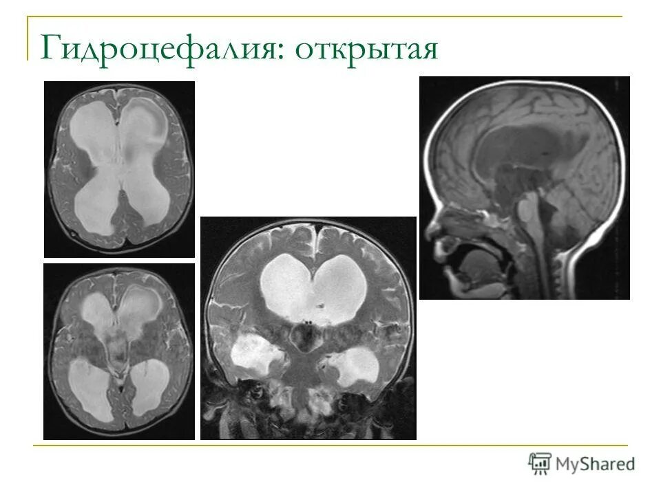 Выражено умеренно гидроцефалия мозга. Арезорбтивная гидроцефалия головного мозга. Внутренняя открытая гидроцефалия головного мозга у взрослых что это. Наружная гидроцефалия головного мозга мрт. Наружная и внутренняя гидроцефалия головного мозга.