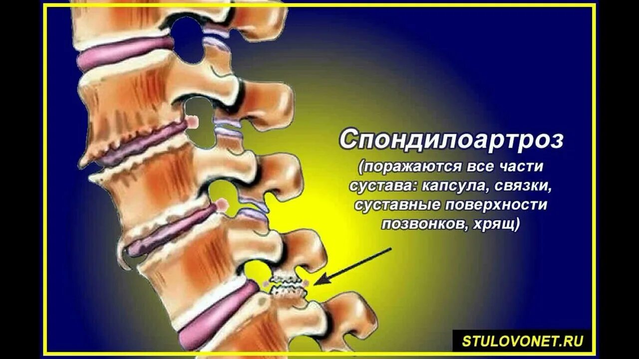 Спондилез поясничного отдела что симптомы и лечение. Спондилоартроз с6-th1. позвонки l1-s1 спондилоартроз. спондилез позвоночника что это. спондилоартроз c3/c4.