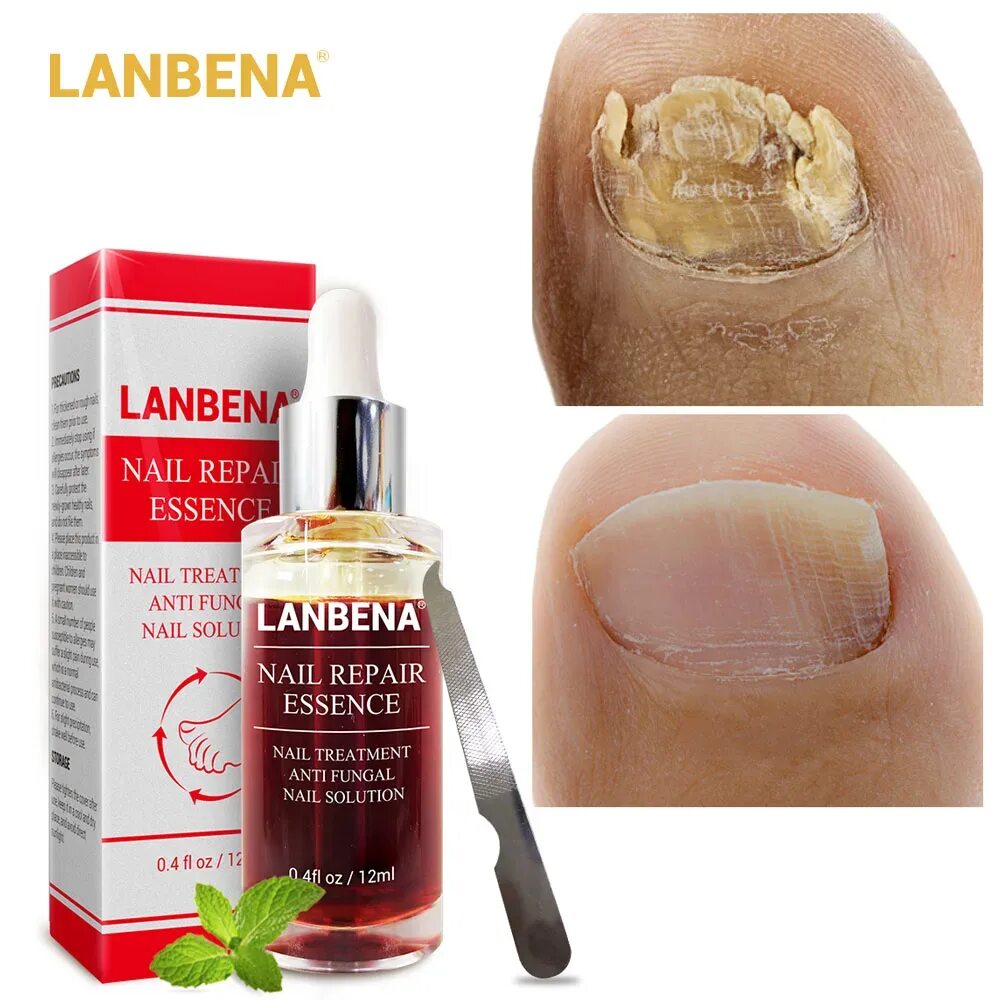 Мазь от грибка ногтей недорогая и эффективная. LANBENA Nail Repair Essence от грибка ногтей. LANBENA сыворотка для ногтей. LANBENA эссенция для ногтей. Средство от грибка ногтей LANBENA Nail Repair Essence 15 ml.