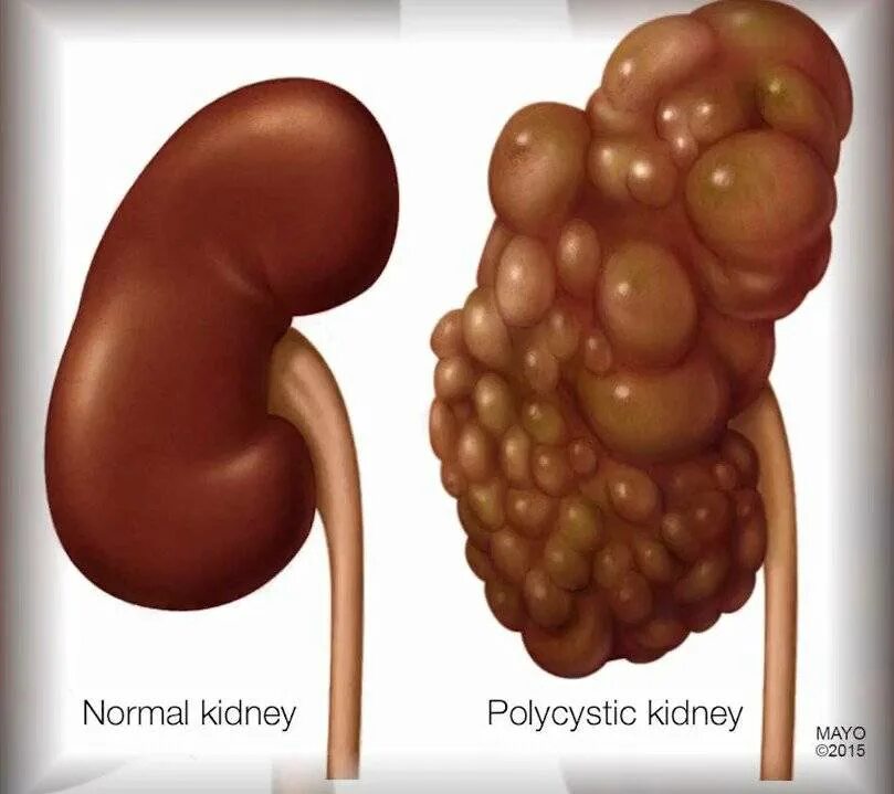Поликистоз почки почки. Поликистоз печени и почек. Поликистозная почечная болезнь. Поликистоз почек нефротический синдром. Болит печень почки