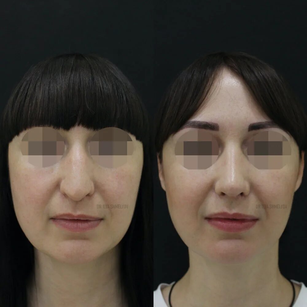 Клювовидный нос ринопластика. Паата джанашия ринопластика. Опустился кончик после ринопластики. Магомед маллаевич ринопластика. Давид манукян ринопластика.