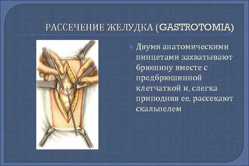 Рассечение термин. Метод рассечения в анатомии. рассечение кольцевидной связки. предбрюшинная клетчатка.