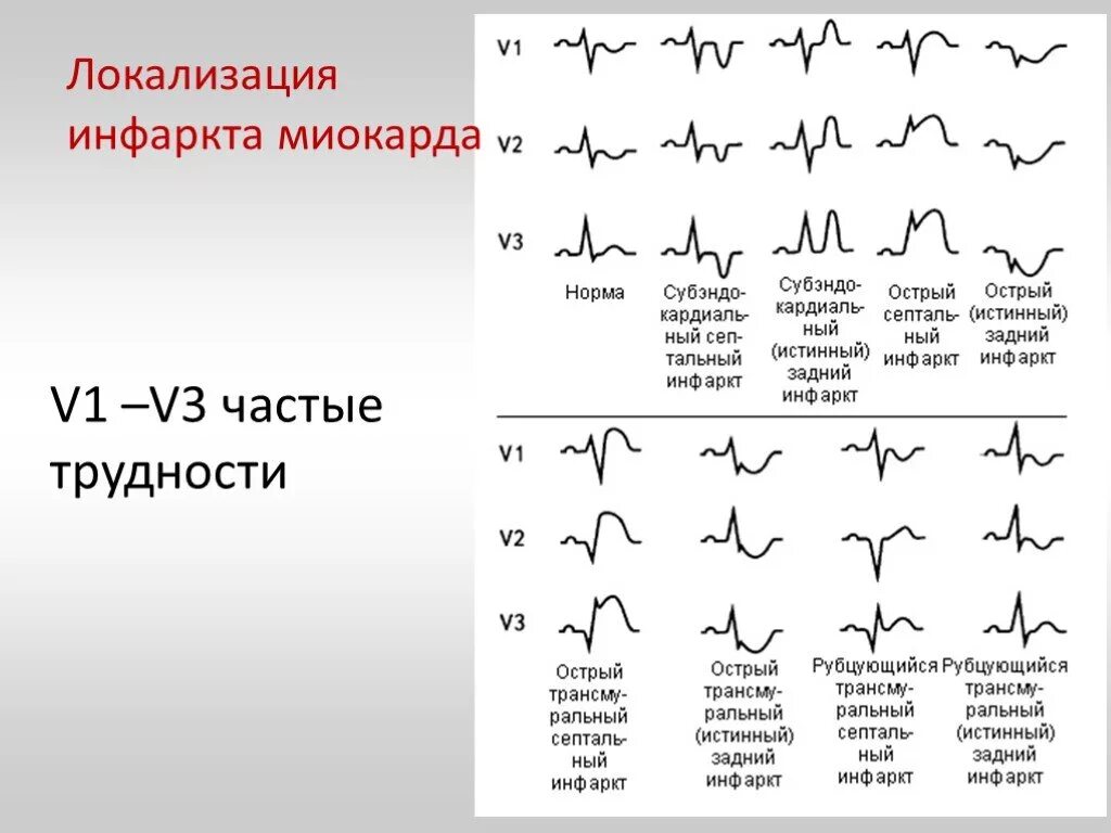 Острый инфаркт миокарда ЭКГ расшифровка. Острейший период инфаркта миокарда на ЭКГ. ЭКГ плёнки инфаркта миокарда по локализации. Инфаркт миокарда ЭКГ v1 v2 v3. Отведение v1 на экг