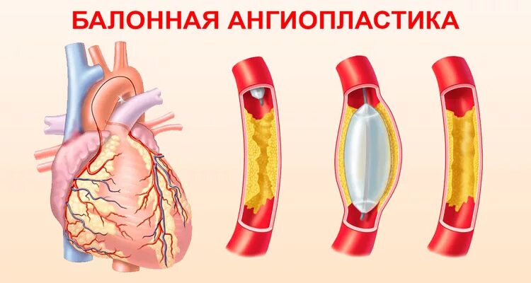 Баллонная коронарная ангиопластика. Баллонная ангиопластика сосудов сердца. Баллонная ангиопластика при ИБС. Аортокоронарное шунтирование баллонная ангиопластика.