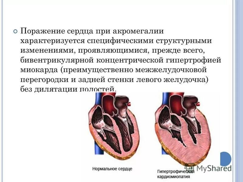 Незначительные изменения миокарда. Гипертрофия миокарда МЖП. Гипертрофия межжелудочковой перегородки сердца причины. Умеренная гипертрофия миокарда межжелудочковой перегородки. Гипертрофия базального отдела МЖП.