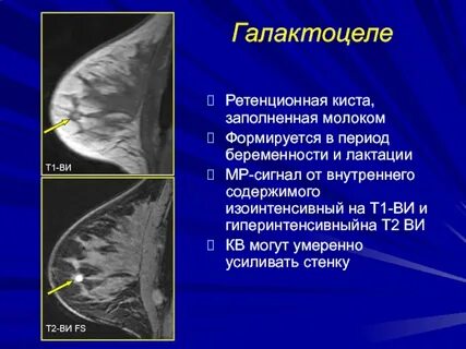 Киста молочных желез может рассосаться