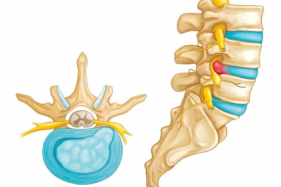 Межпозвонковая грыжа поясничного отдела лечение. Грыжа межпозвонкового диска поясничного отдела. Позвоночная грыжа l1-l2. Междисковая грыжа позвоночника. Протрузия 5 диска поясничного отдела позвоночника.