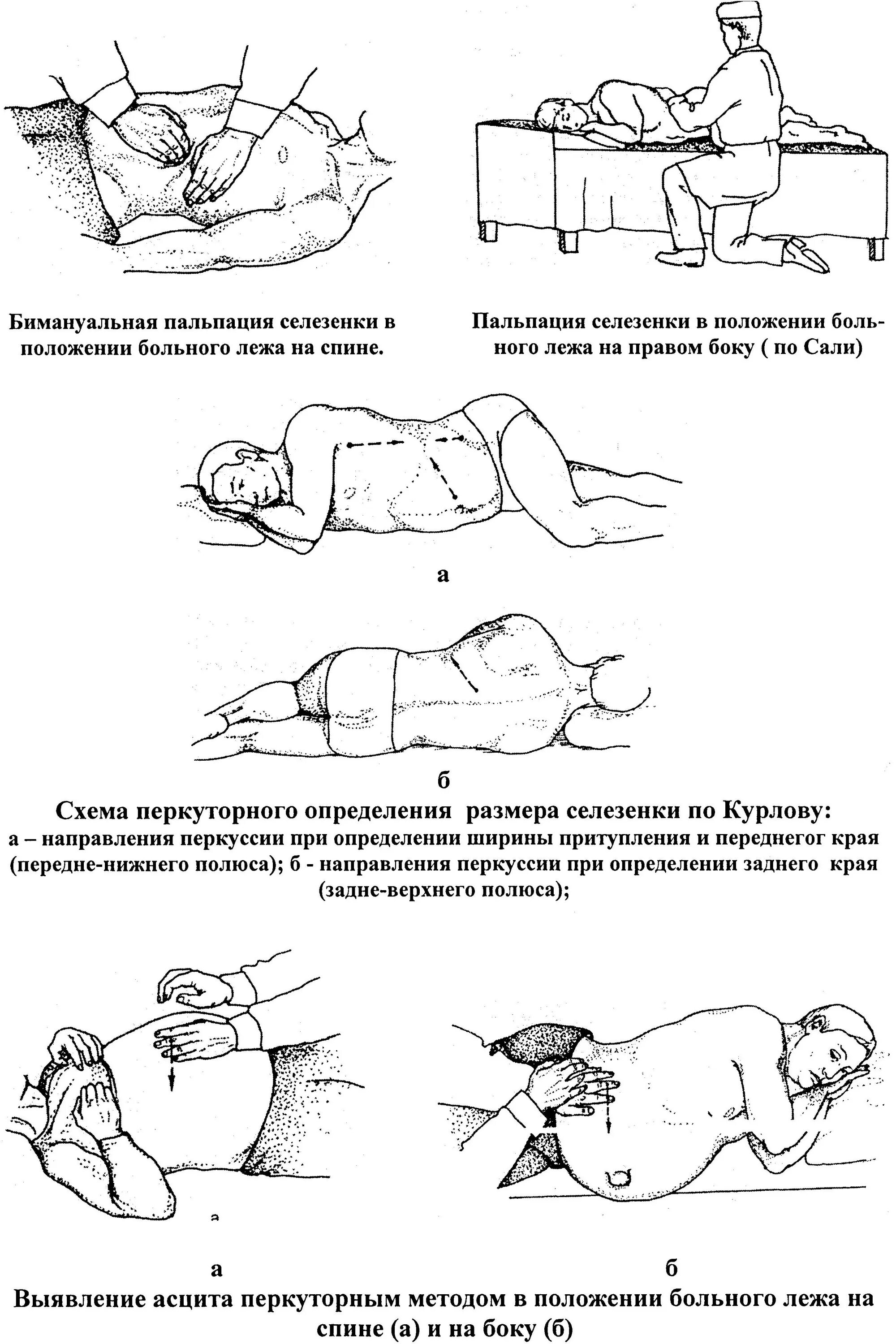 Массаж простаты где. Пальцевое ректальное исследование предстательной железы. Хронический гломерулонефрит пальпация. Положение пациента при перкуссии селезенки. Пальпация селезенки при спленомегалии.
