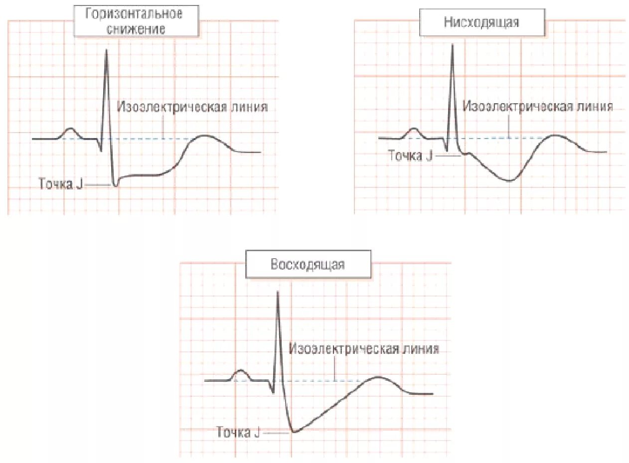 Депрессия сегмента st. Депрессия сегмента St на ЭКГ v5 v6. Депрессия сегмента ст на ЭКГ. Подъем и депрессия сегмента St на ЭКГ. Косонисходящая депрессия сегмента St.