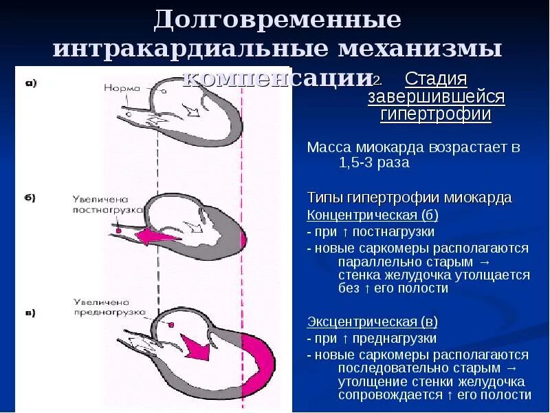 Концентрическая гипертрофия желудочка. Гипертрофия миокарда при гипертонической болезни концентрическая. Концентрический тип ремоделирования миокарда. Стеноз аортального клапана гемодинамика схема. Эксцентрический тип гипертрофии миокарда.