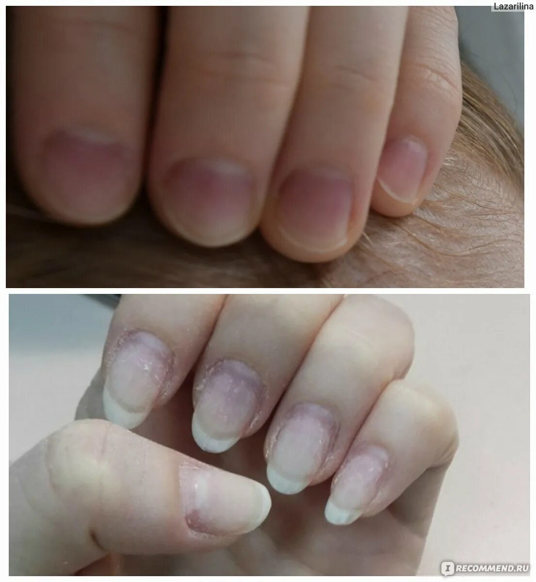 Ногти до и после маникюра. Грибок ногтей после гель лака. Грибок ногтей после гель. Ногти после геля стали тонкие