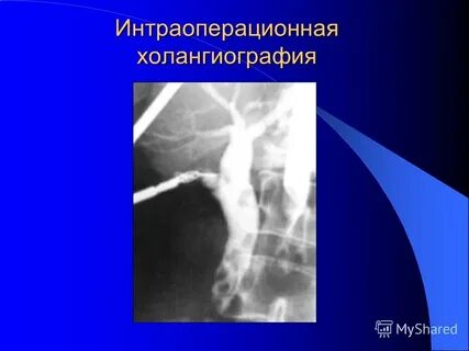 Холангиография