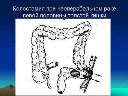 Операции при раке прямой кишки