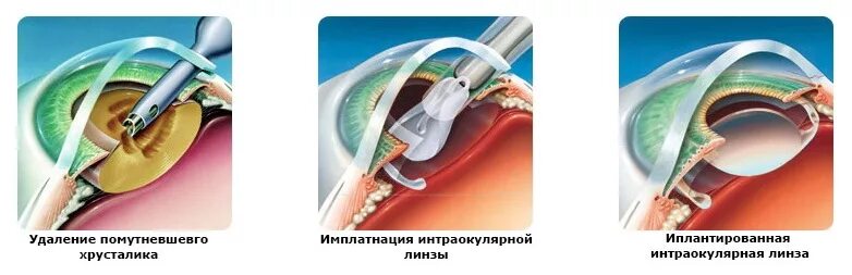 Как называется операция по замене хрусталика глаза