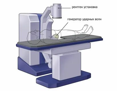 Ультразвук камни