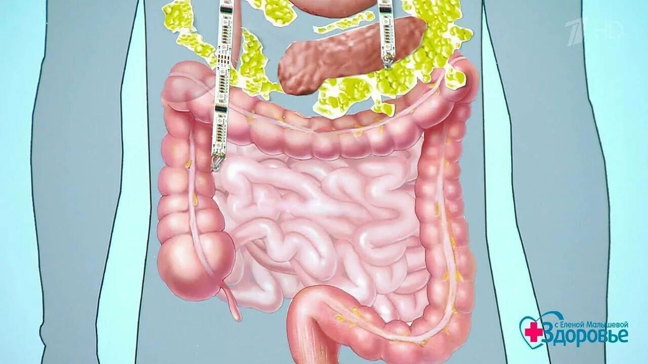 Синдром ленивого кишечника. Запор гастроэнтерология. Ленивый кишечник симптомы и лечение