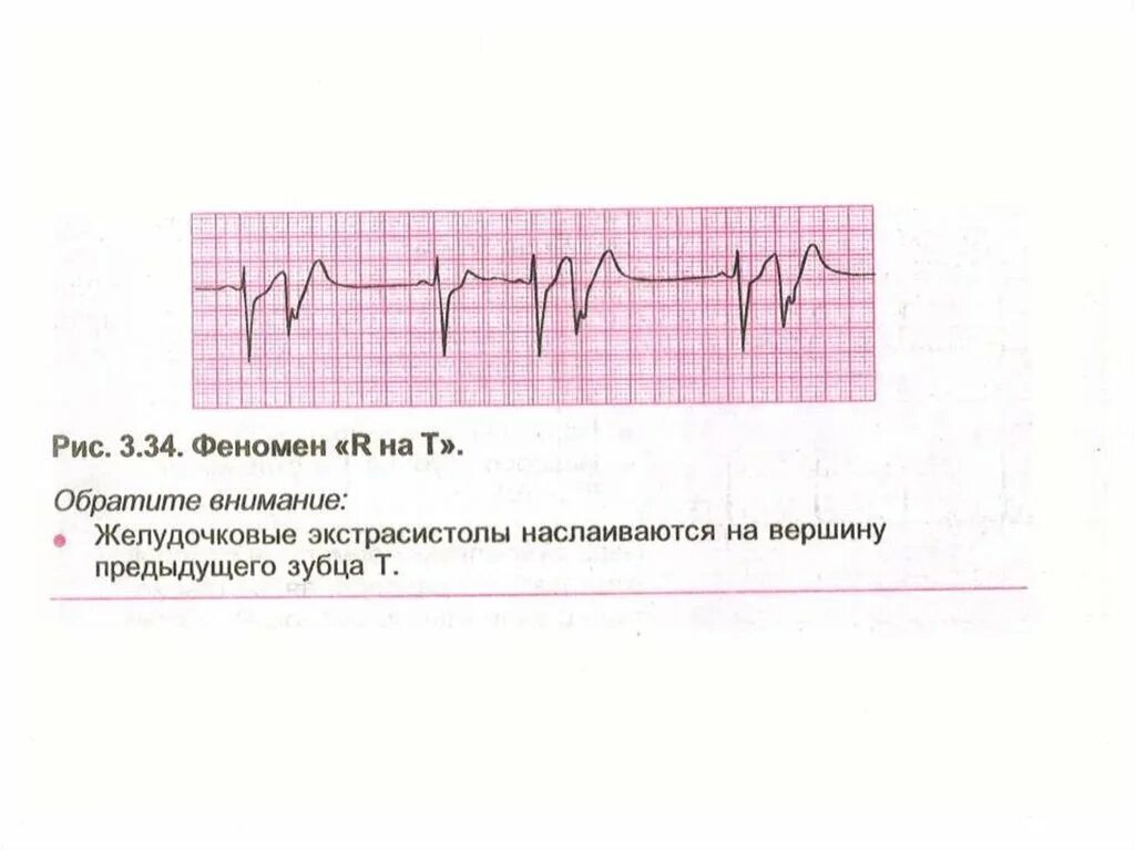 Политопная желудочковая экстрасистолия на ЭКГ. ЭКГ монотопные желудочковые экстрасистолы. Политопные желудочковые экстрасистолы на ЭКГ. Желудочковая экстрасистолия на ЭКГ политопные. Политопные экстрасистолы