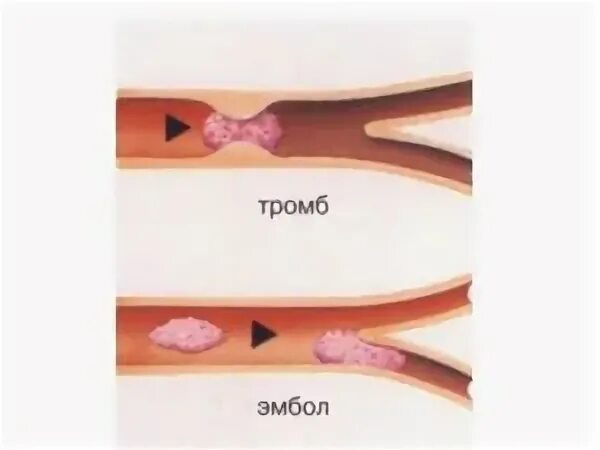 Отличие тромба от эмбола. Эмболия кровеносных сосудов. Эмболия тромбы