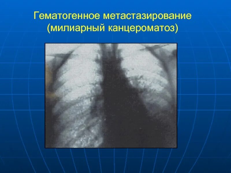 Гематогенное метастазирование