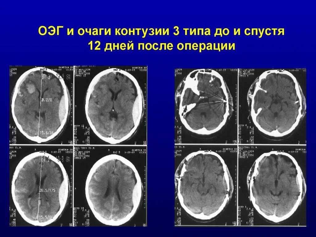 Что такое контузия словами и последствия. Очаг контузии в головном мозге. Очаги контузии 3 типа. Очаг контузии головного мозга 1 типа.