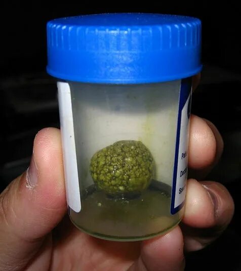 Коричневые вкрапления в моче. Как выглядят камни в моче. Как выглядят камни в моче. Камни оксалаты фосфаты ураты. Конкремент оксалат кальция.