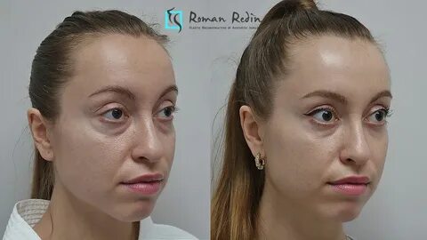 Трансконъюнктивальная блефаропластика
