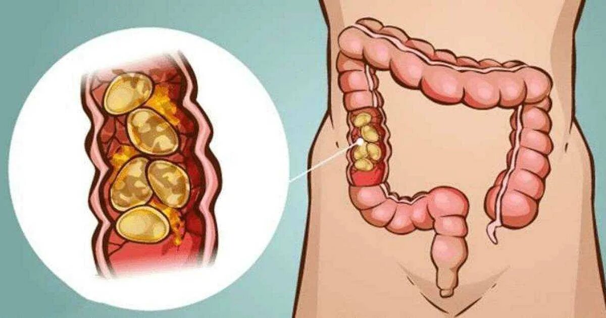 Дефекация при запоре. Каловые камни в кишечнике.