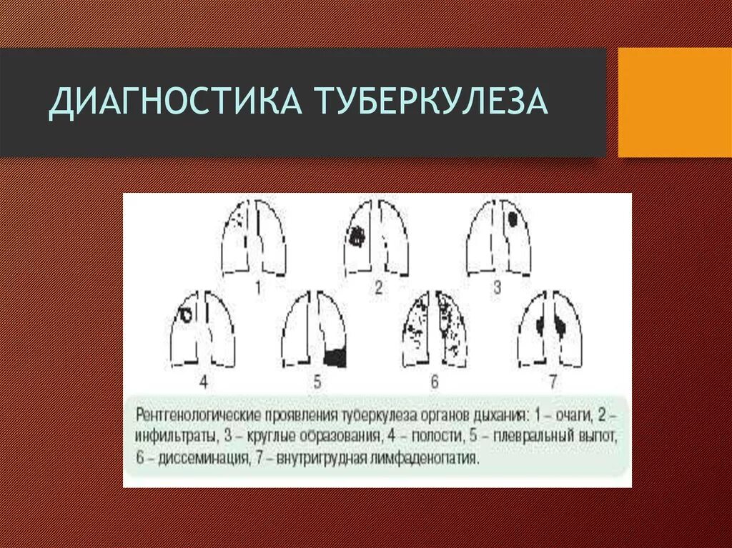 Диагностика туберкулеза. Метод выявления туберкулеза. Выявление туберкулеза у взрослых. Выявление и диагностика туберкулеза легких. Обследование при туберкулезе легких