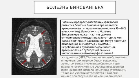 Перивентрикулярное белое вещество