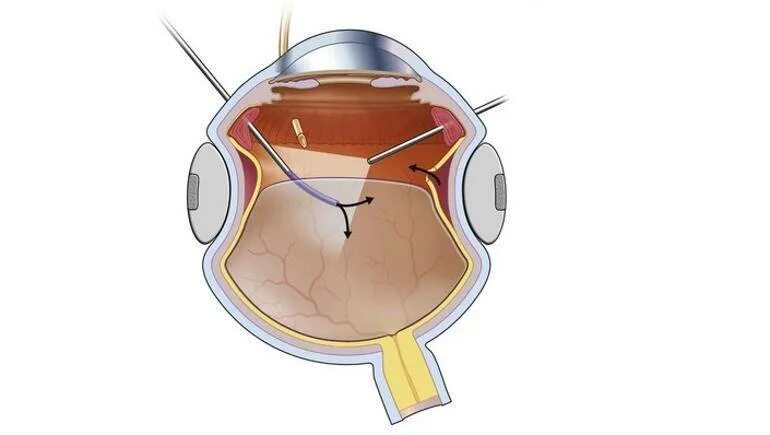 Отслойка сетчатки экстрасклеральное пломбирование. Отслойка сетчатки циркляж. Отслойка сетчатки баллонирование склеры. Отслойка сетчатки витрэктомия.