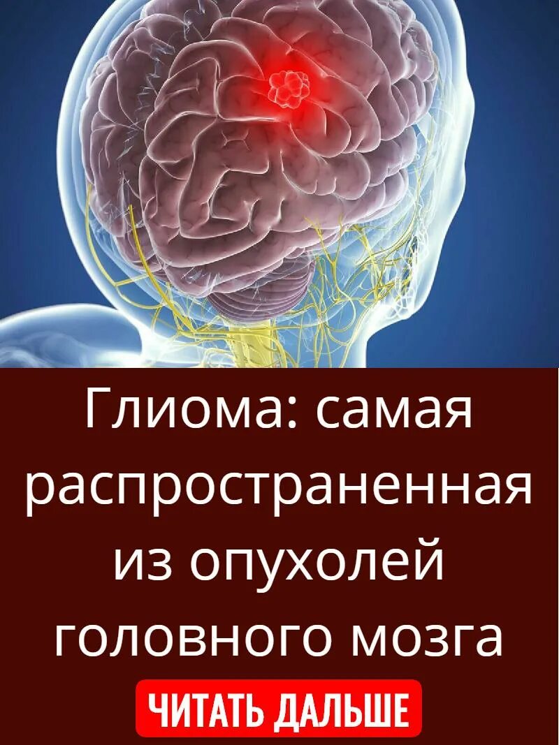 Объемное образование головного мозга. Доброкачественная опухоль головного мозга. Что такое глиома