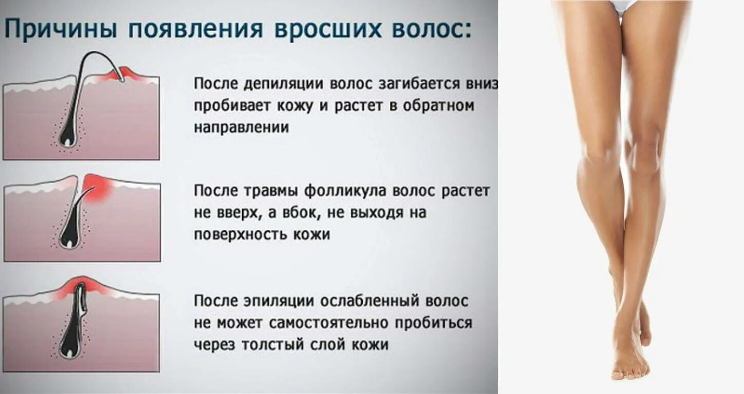 Как сделать чтобы росли волосы на ногах. Вросшие волосы типы вросших волос. причина возникновения вросших волос. врозжие волосы.