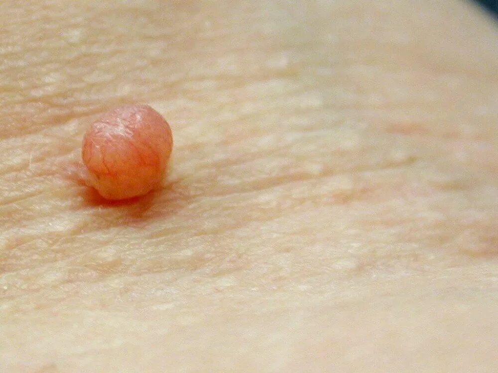 Фолликулярный дерматоз. Фолликулярный гепертоз. Бугорков. Луганские писатели и поэты. Окклюзионная поверхность.