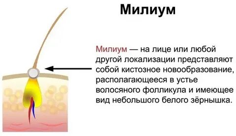Устье волосяного фолликула